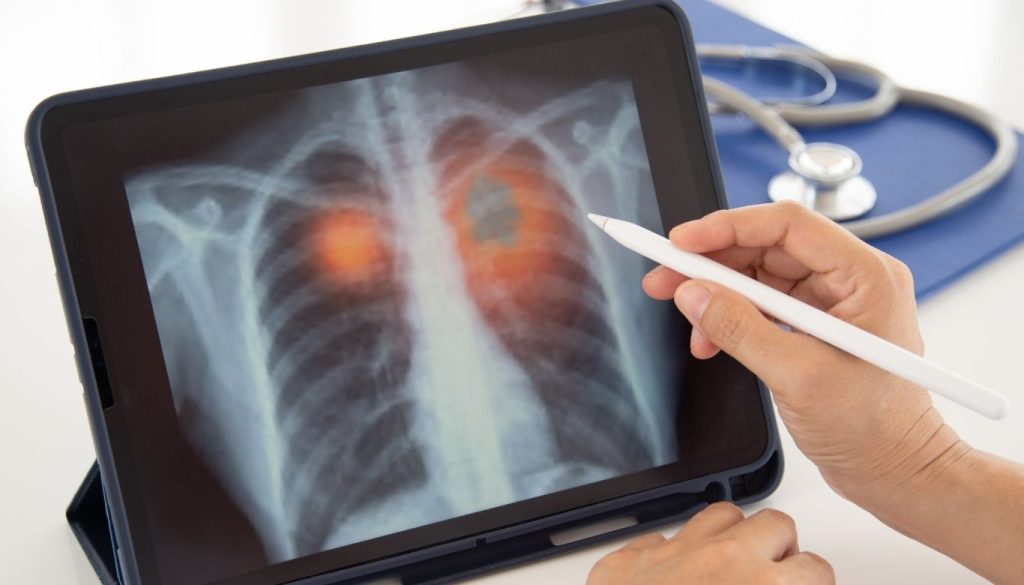 community acquired pneumonia canada​ 