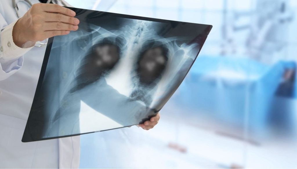 pneumonia versus flu​ 