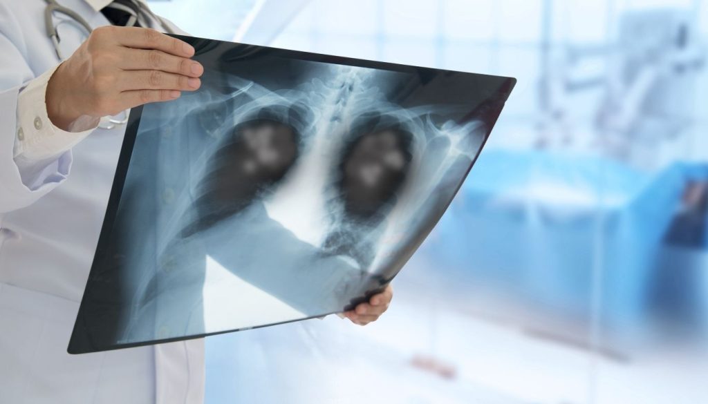 community acquired pneumonia canada​ 