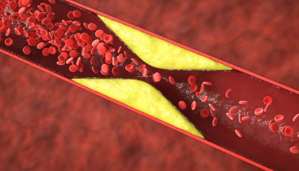 can high cholesterol cause fatigue