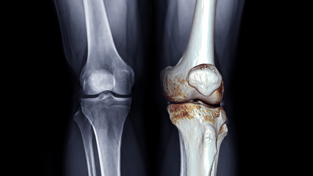 how to dissolve bone spurs naturally​