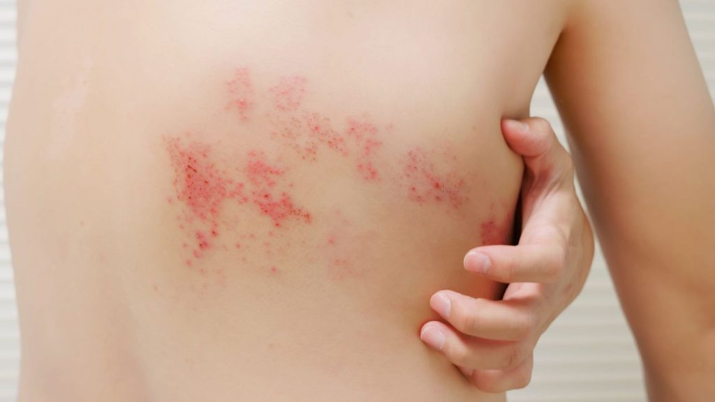 shingles vaccine bc​